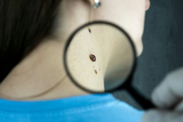 How to visit a dermatologist in Luxembourg